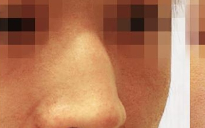 話說鼻樑起節就是駝峰鼻嗎？