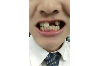 門牙無豁口的人如何化險為夷呢