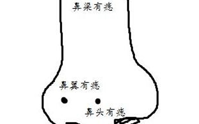 女人招惹爛桃花跟這顆惡痣有關係