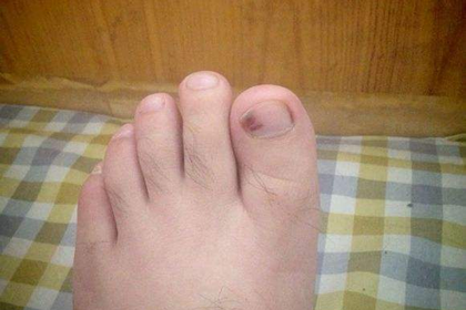男人長希臘腳對桃花運有沒有幫助