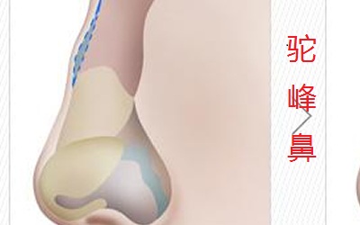 駝峰鼻面相的男性很難看嗎？