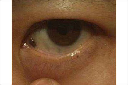 眼白有痣的男人事業運會不會不順利