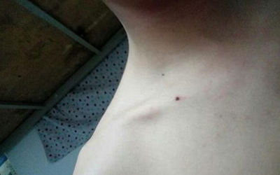 男人鎖骨下長痣好不好？