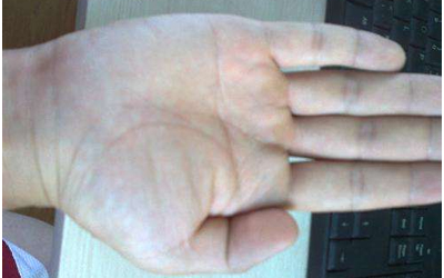 智慧線型假斷掌是怎麼一回事？