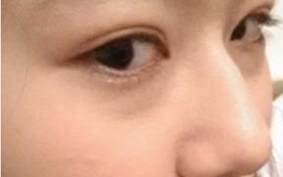 話說鼻樑起節就是駝峰鼻嗎？